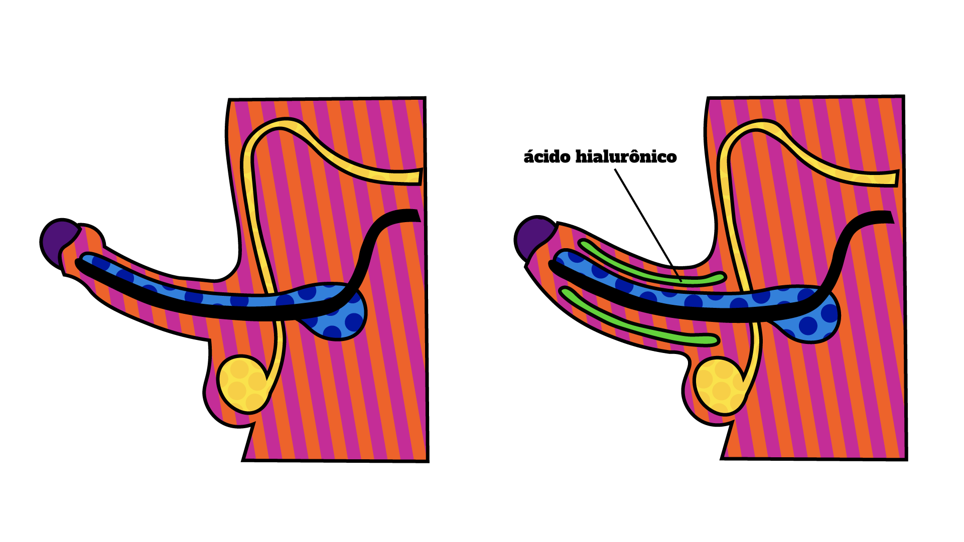 ilustração de bioplastia e engrossamento