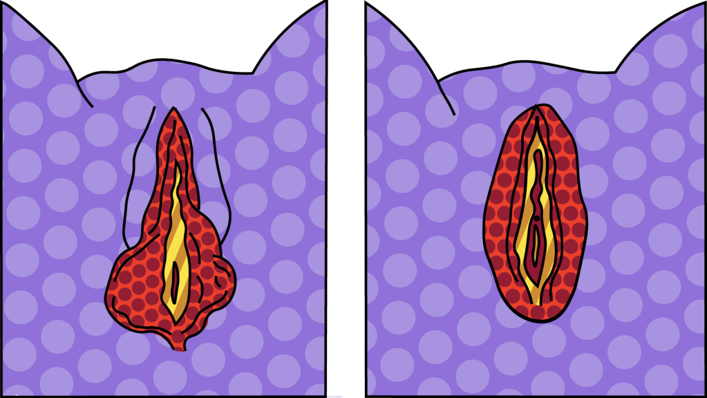 ilustração de labioplastia